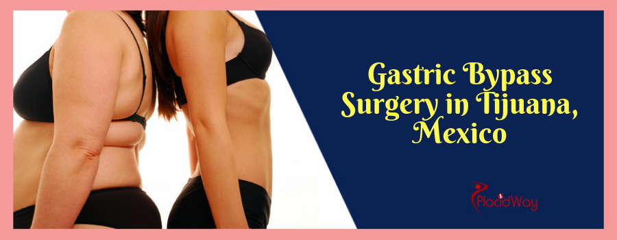 Gastric Bypass Surgery in Tijuana, Mexico